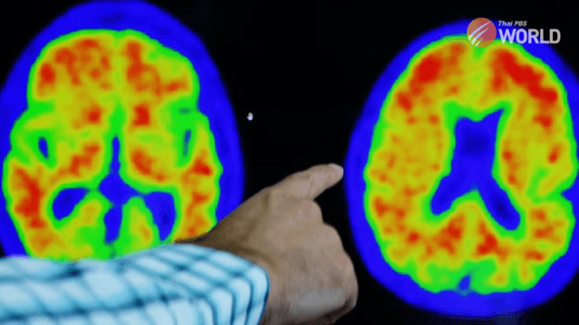 Lilly drug slows Alzheimer's progression by 35% in trial