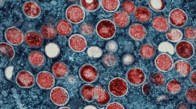 Thailand reports suspected case of new mpox strain