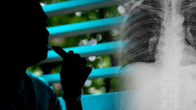 Doctors warn against using e-cigarettes, risk of severe pneumonia Doctors warn against using e-cigarettes, risk of severe pneumonia
